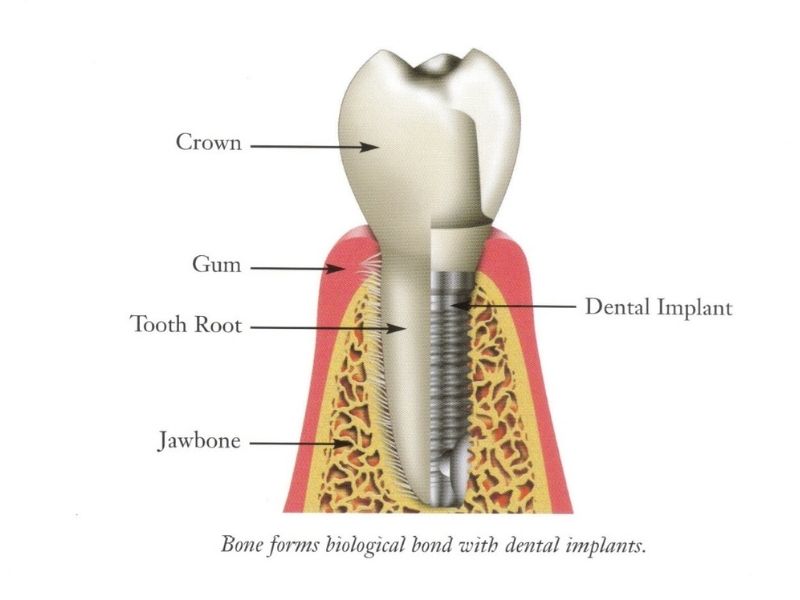 dental-implant-system