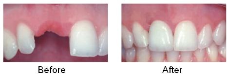 Single Tooth Replacement