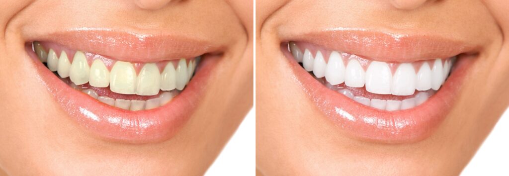 Where can I get Louisville Teeth Whitening?