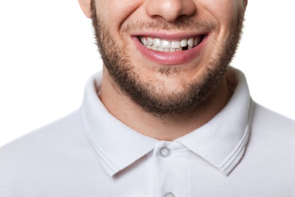 Dental Implants: A great Solution for Lost or Missing Teeth