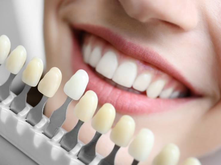 Teeth Whitening: Simple