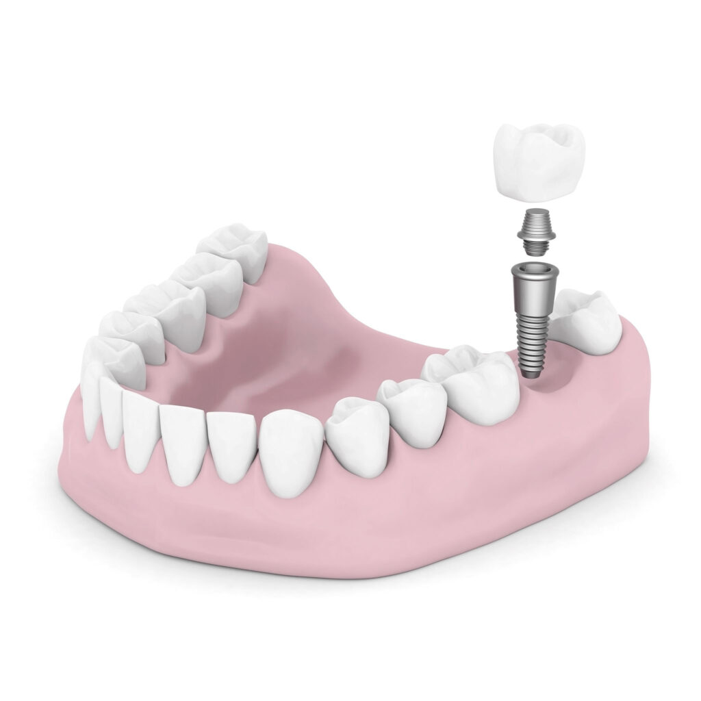 Dental Implants 40205