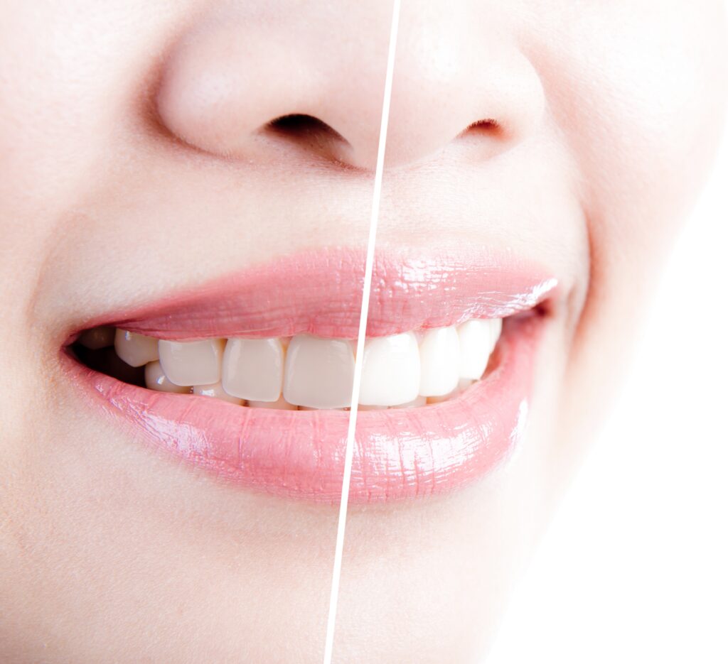 Teeth Whitening in Louisville