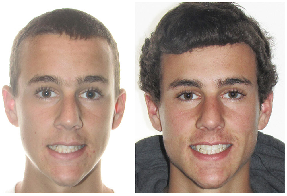 Invisalign Before & After Photo