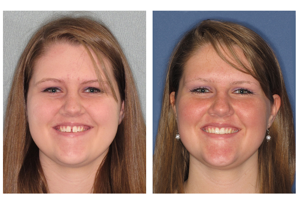 Invisalign Before & After Photo