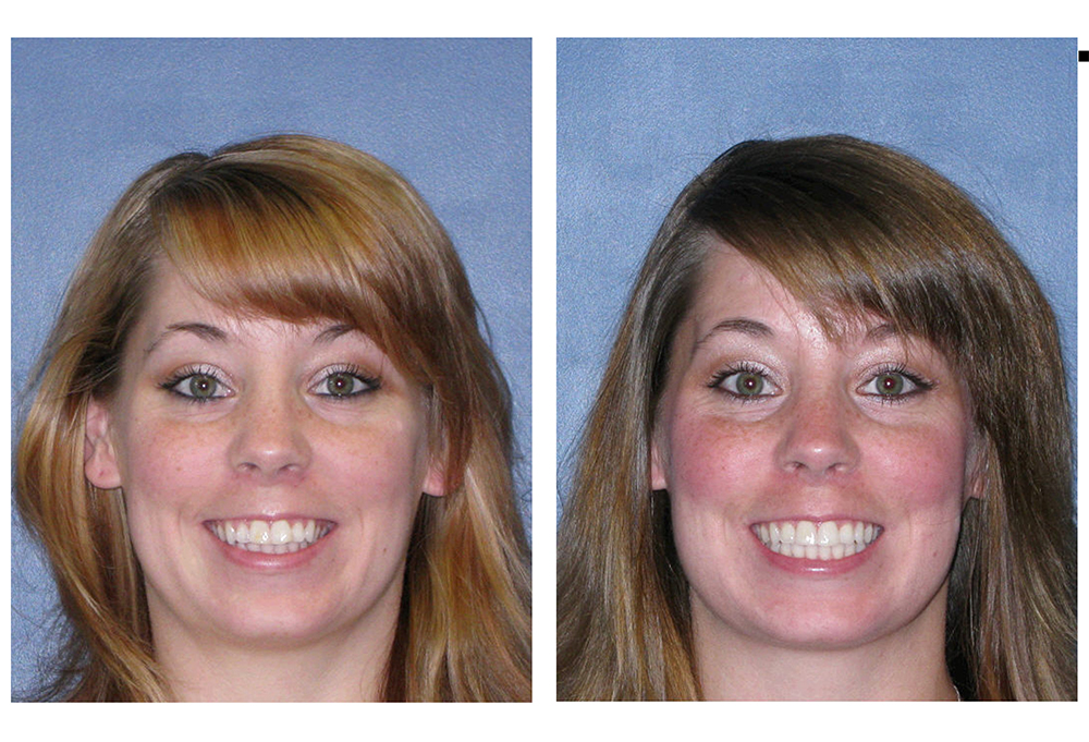Invisalign Before & After Photo