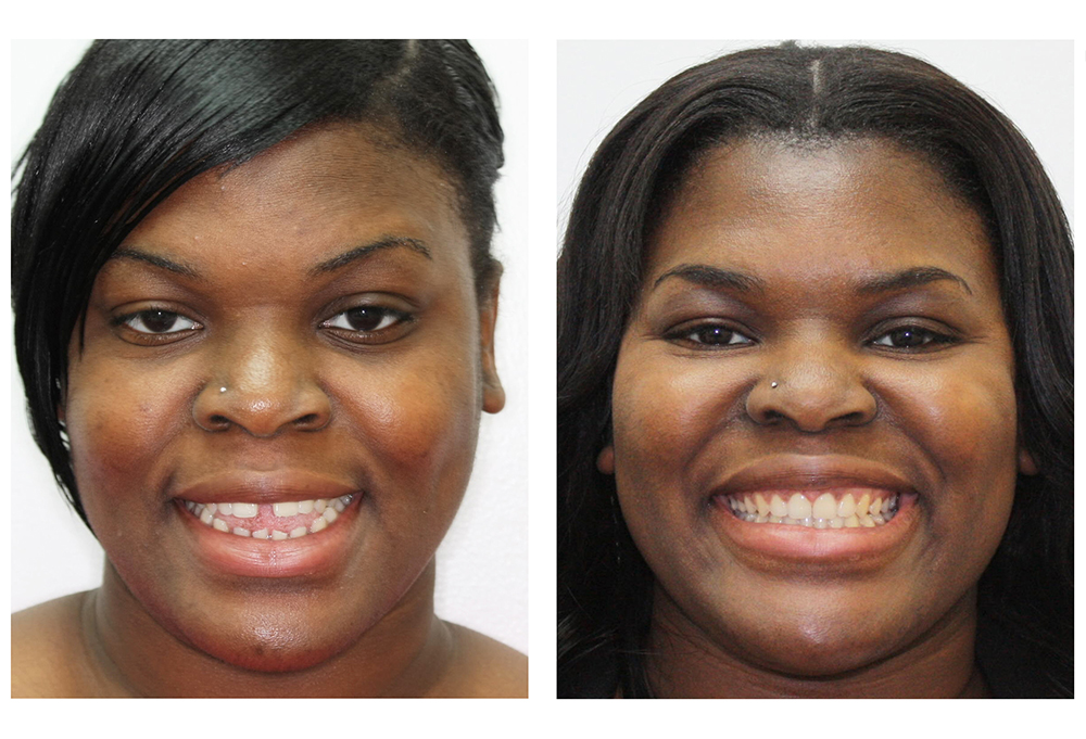 Invisalign Before & After Photo
