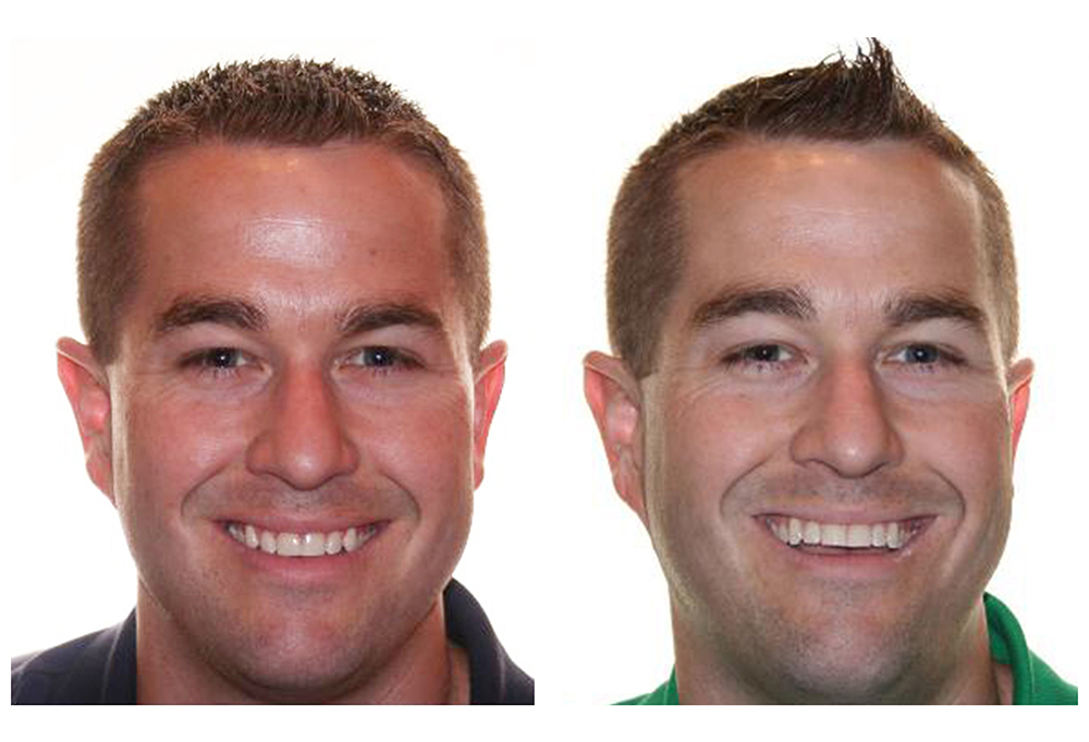 Invisalign Before & After Photo