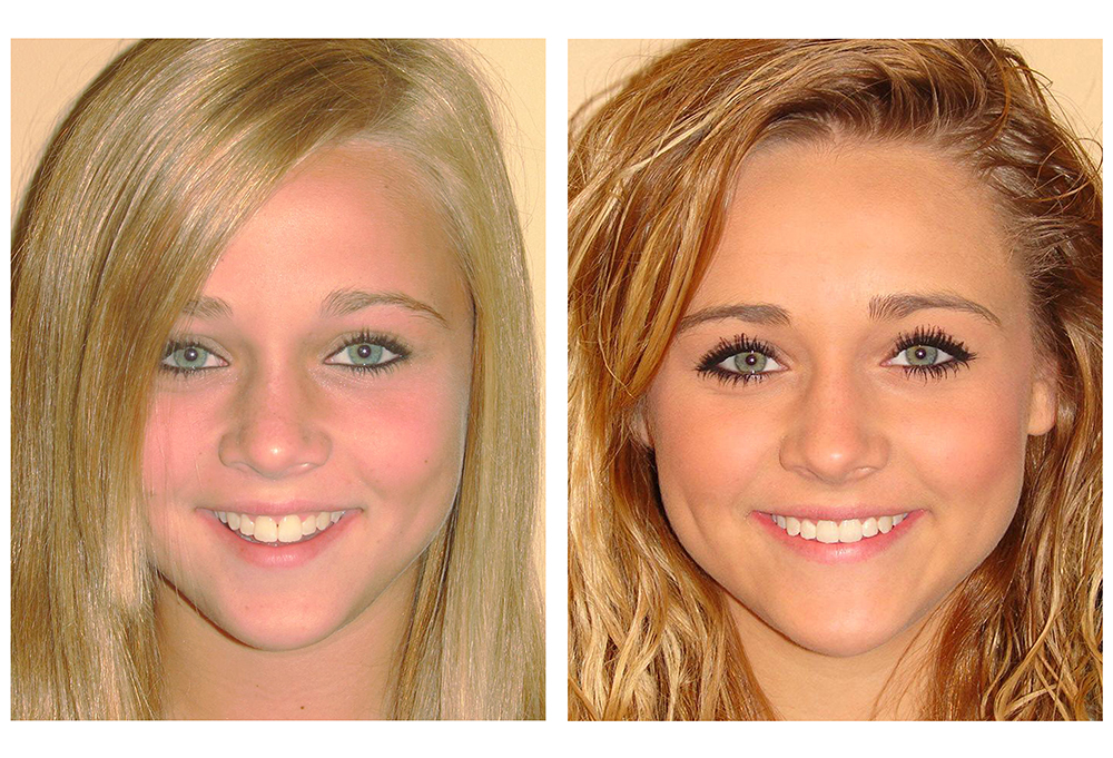 Invisalign Before & After Photo